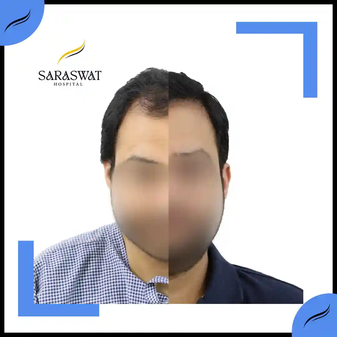 Hair Transplant Before and After