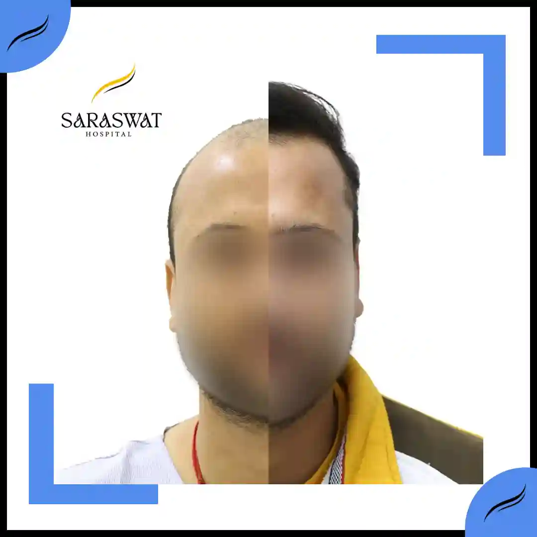 Hair Transplant Before and After Results | Hair Transplant Results