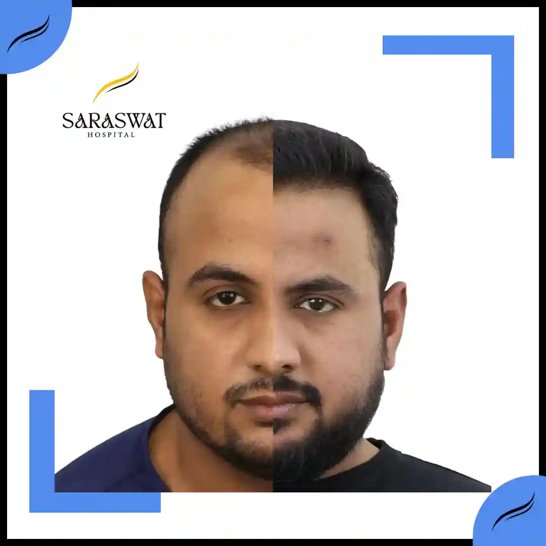 Hair Transplant Before and After Results | Hair Transplant Results