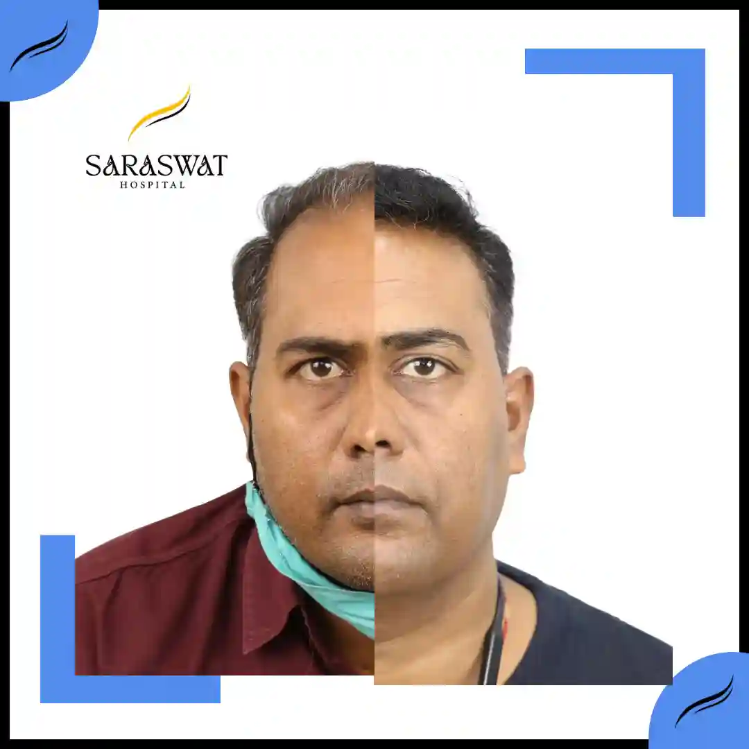 Hair Transplant Before and After Results | Hair Transplant Results