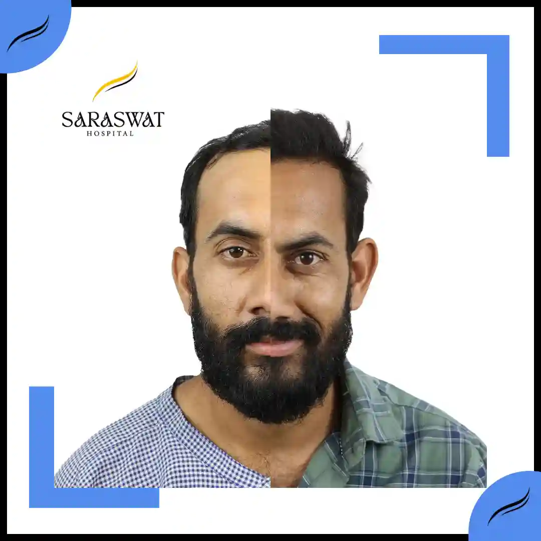 Hair Transplant Before and After | Hair Transplant Results