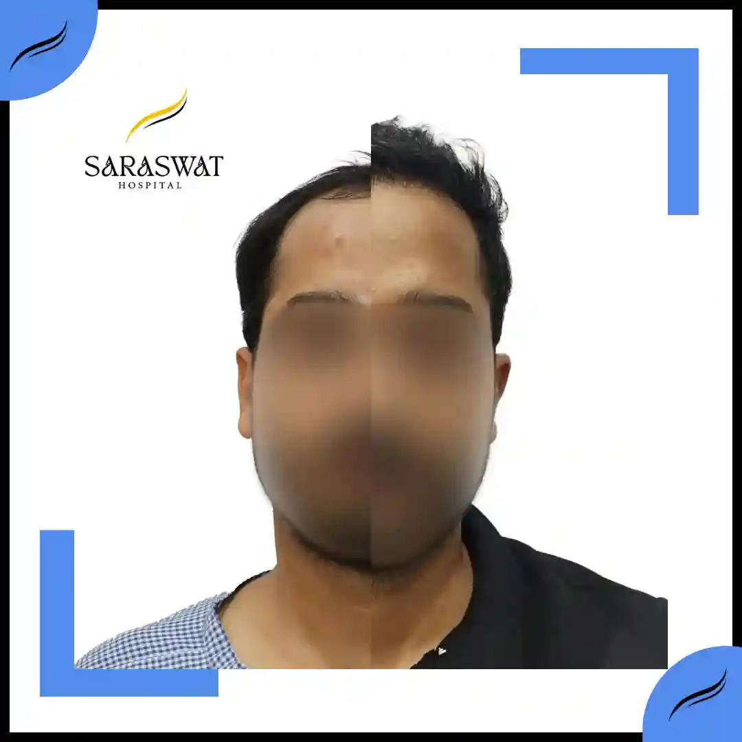 Hair Transplant Before and After | Hair Transplant Results