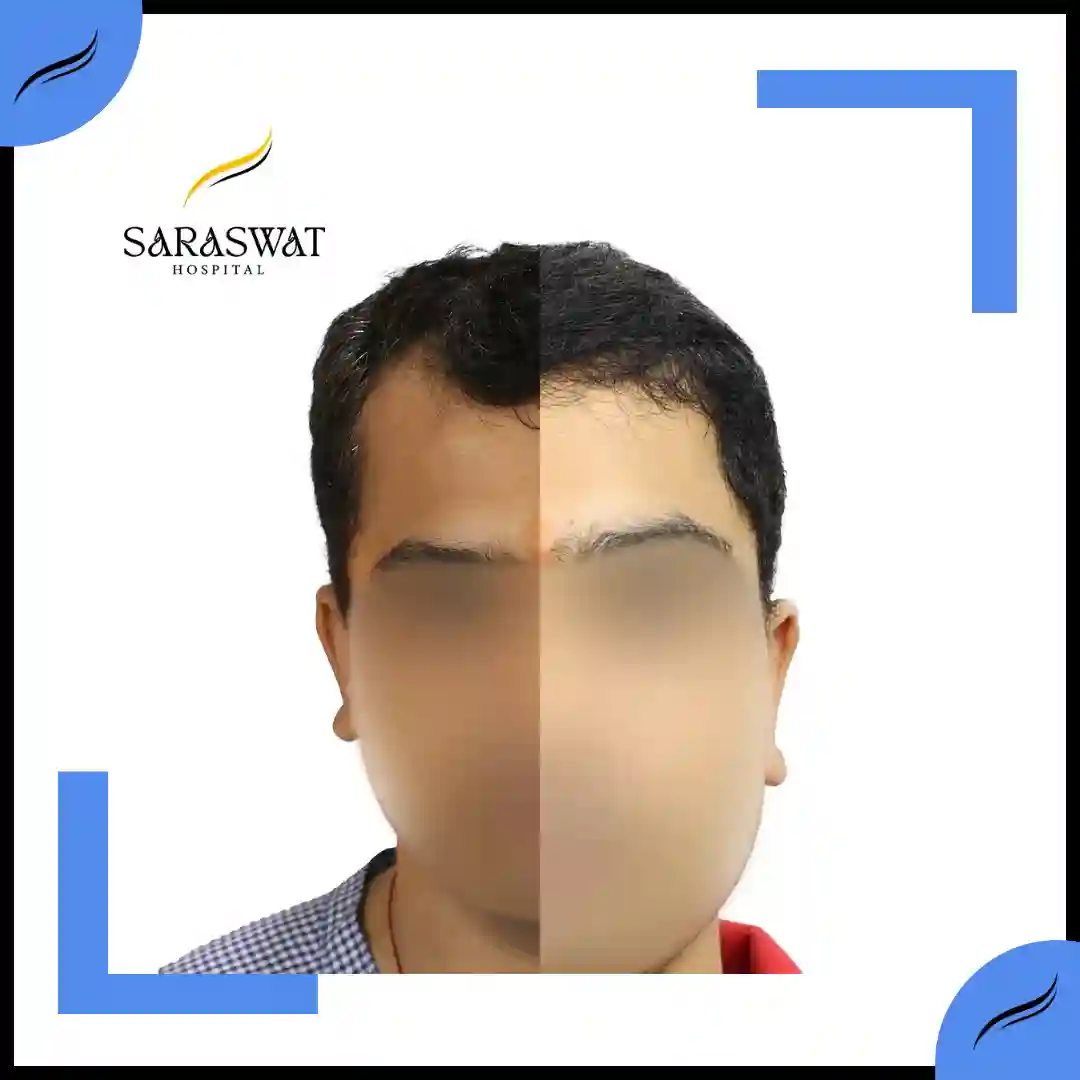 Hair Transplant Before and After | Hair Transplant Results