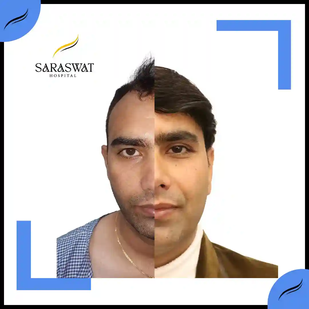Hair Transplant Before and After | Hair Transplant Results