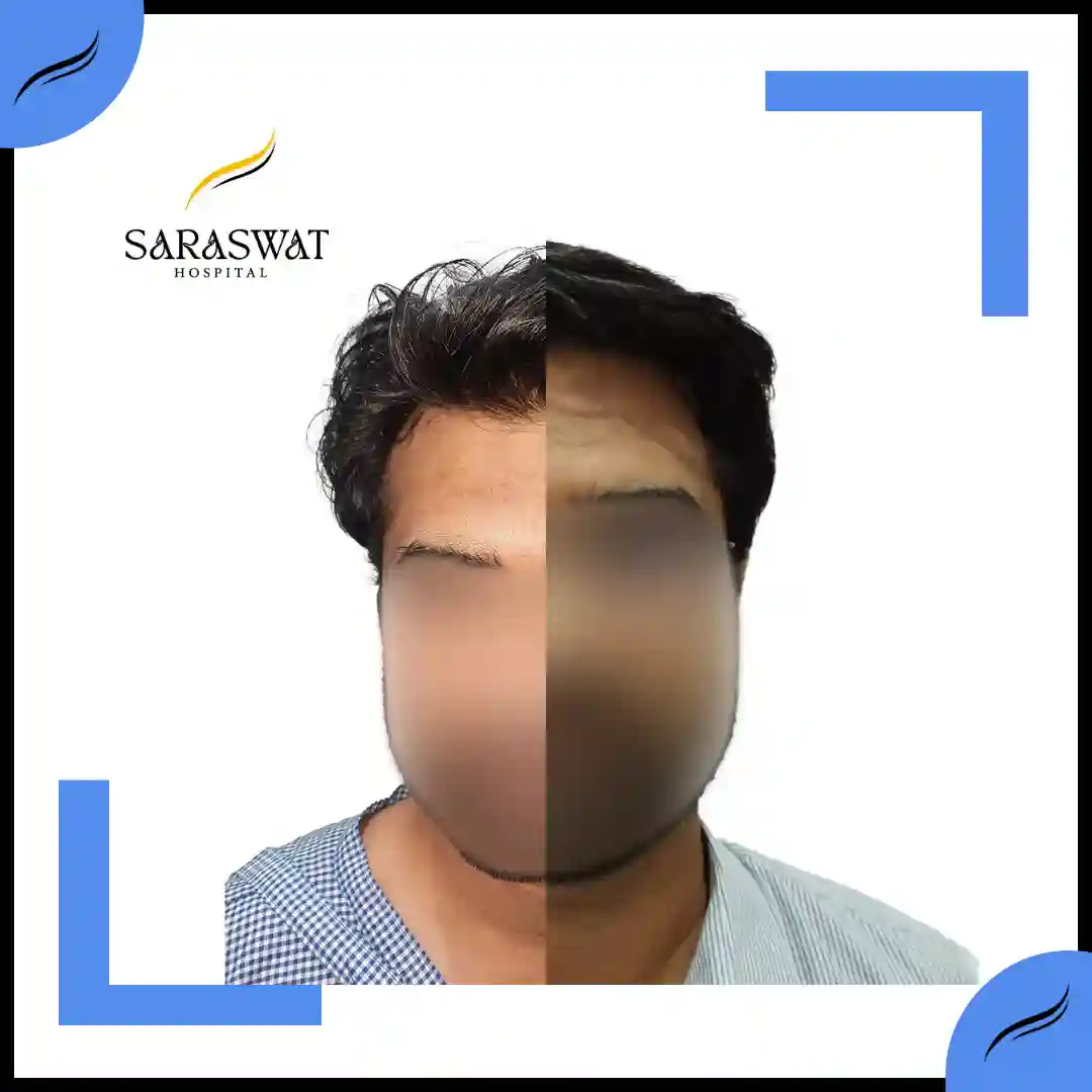 Hair Transplant Before and After | Hair Transplant Results