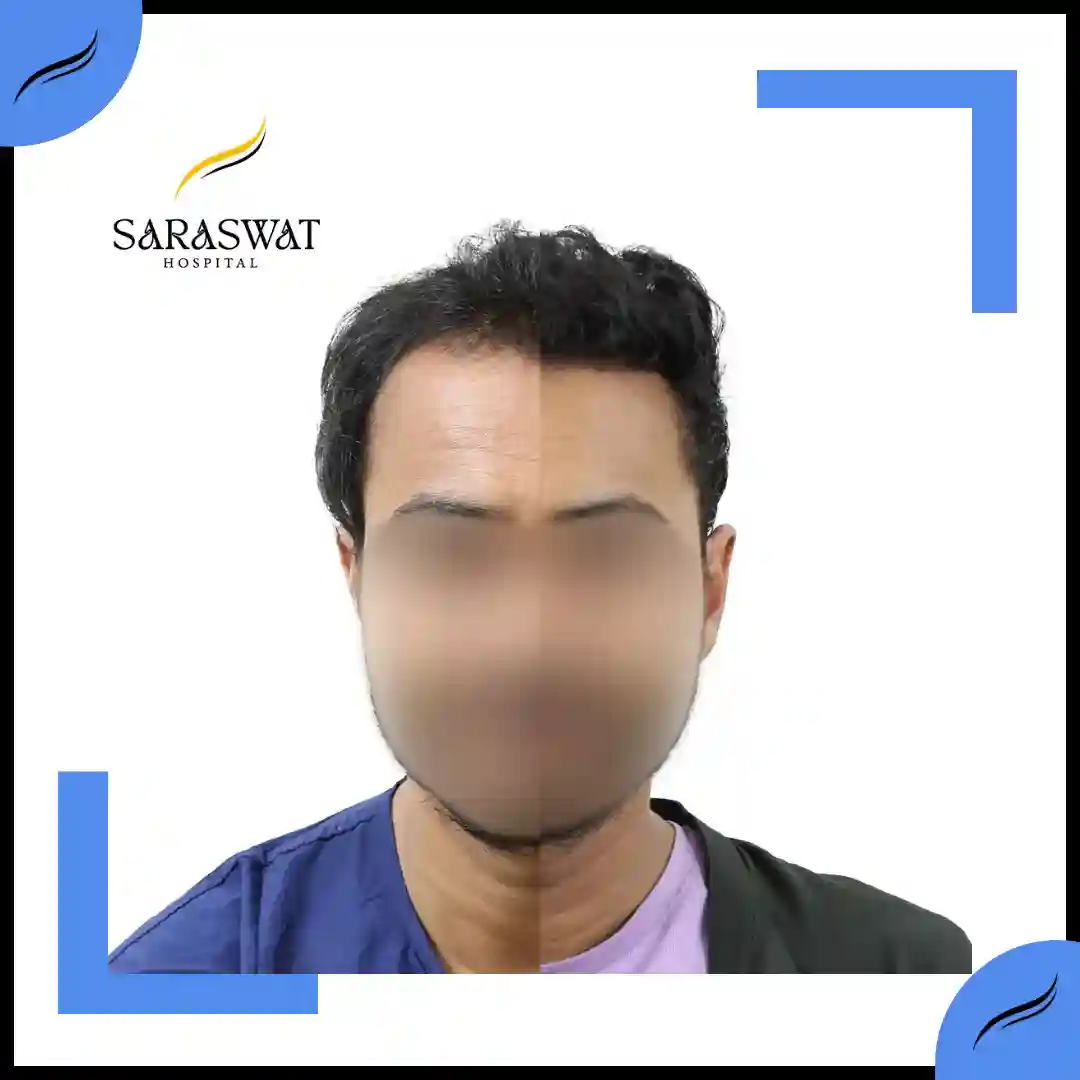 Hair Transplant Before and After | Hair Transplant Results