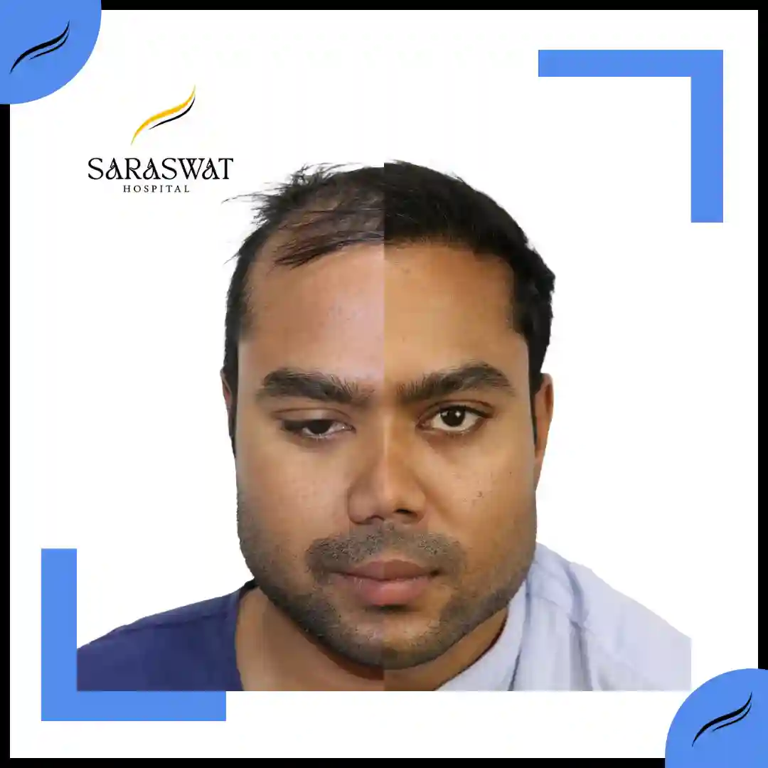 Hair Transplant Before and After | Hair Transplant Results