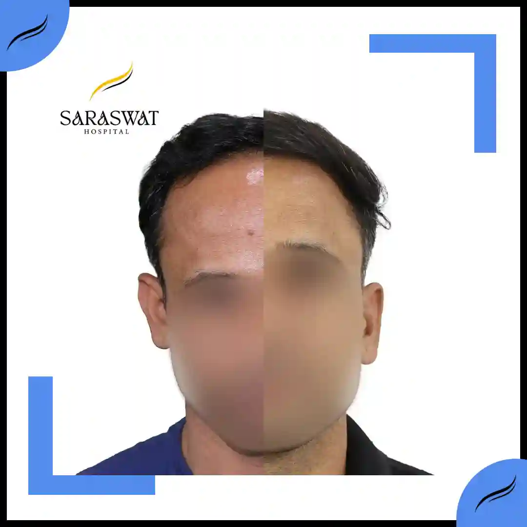 Hair Transplant Before and After | Hair Transplant Results