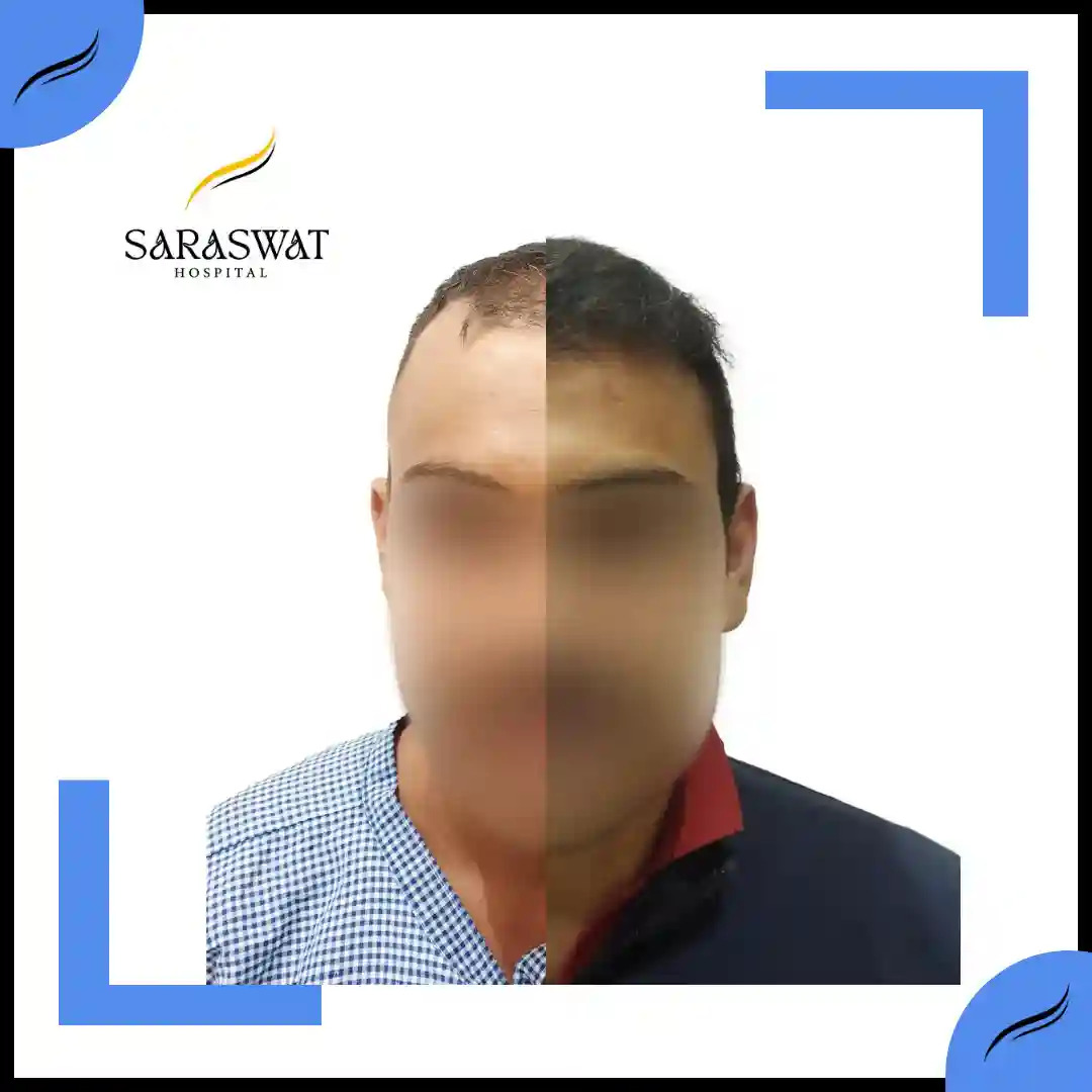Hair Transplant Before and After | Hair Transplant Results