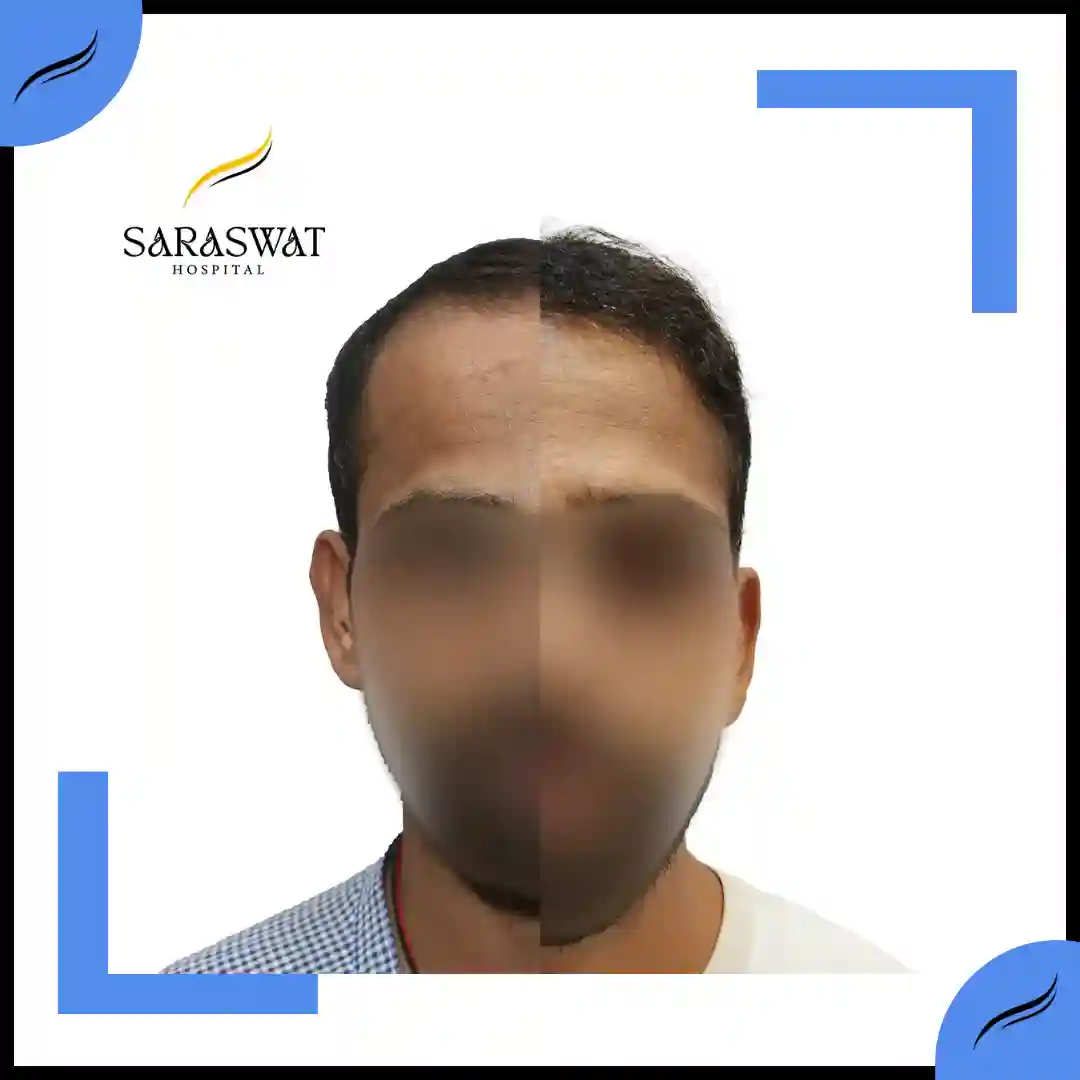 Hair Transplant Before and After | Hair Transplant Results