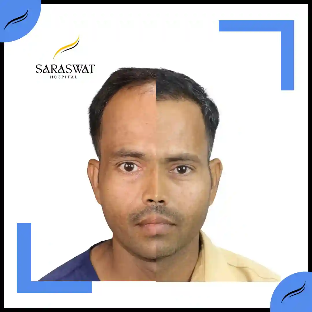 Hair Transplant Before and After | Hair Transplant Results