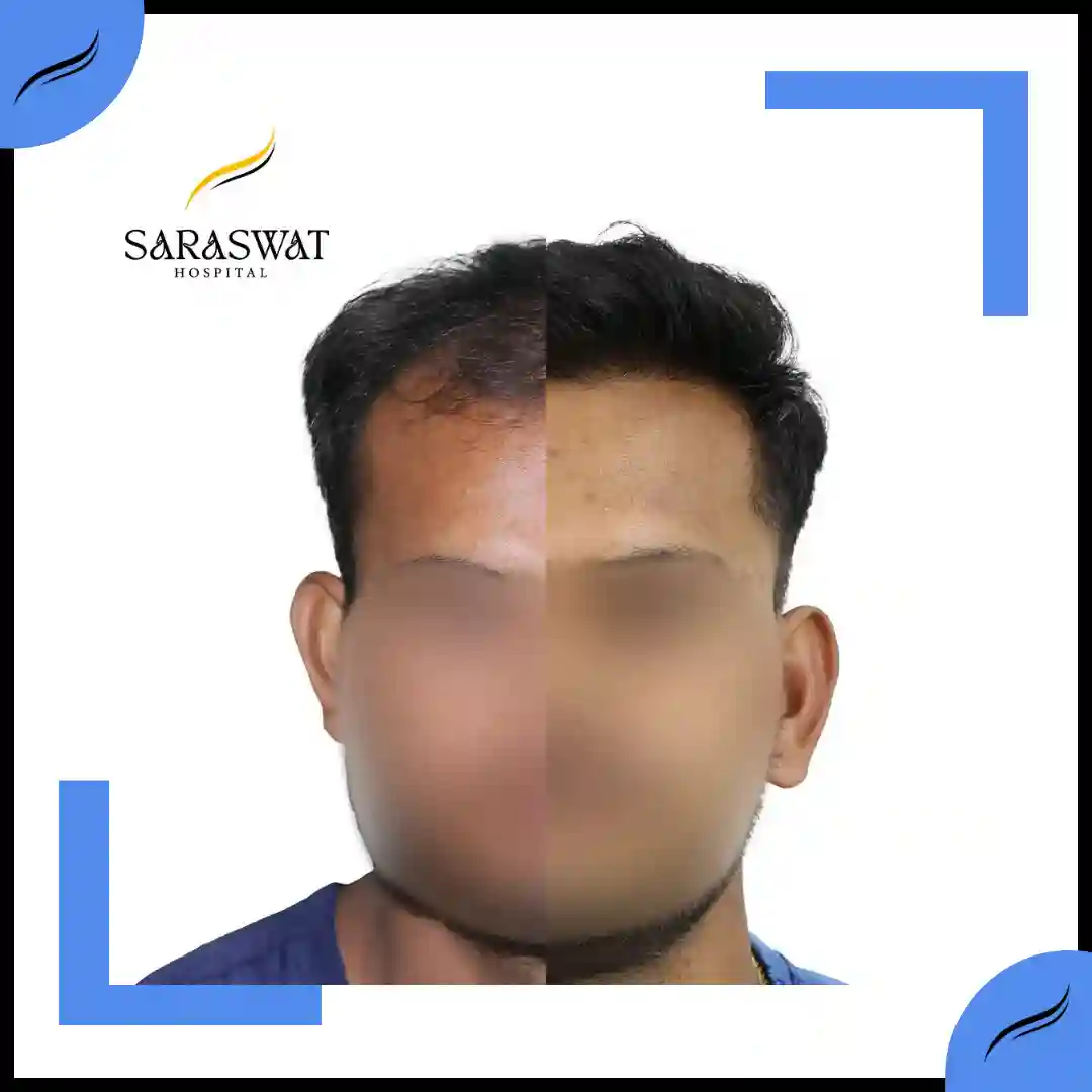 Hair Transplant Before and After | Hair Transplant Results