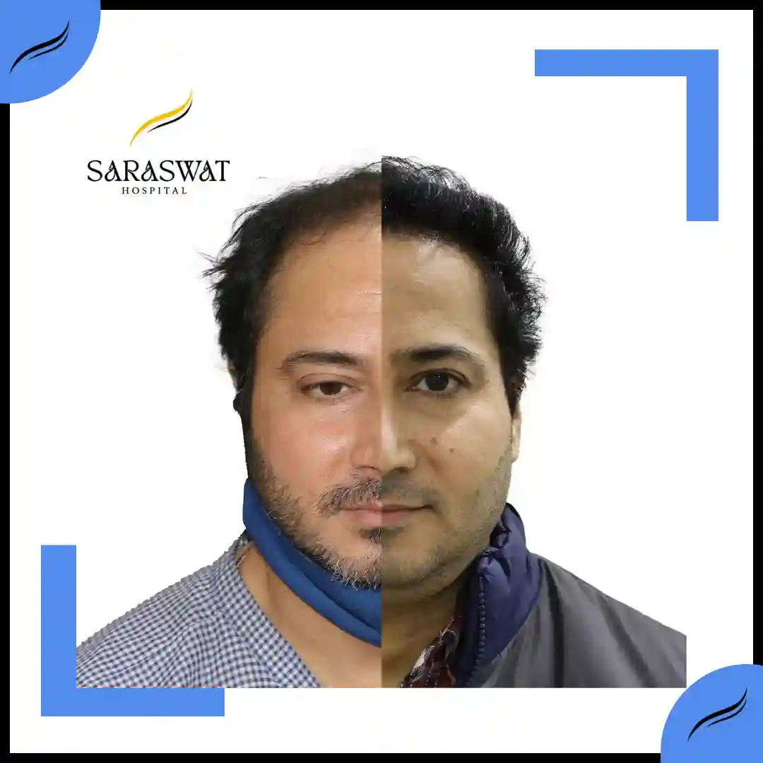 Hair Transplant Before and After | Hair Transplant Results