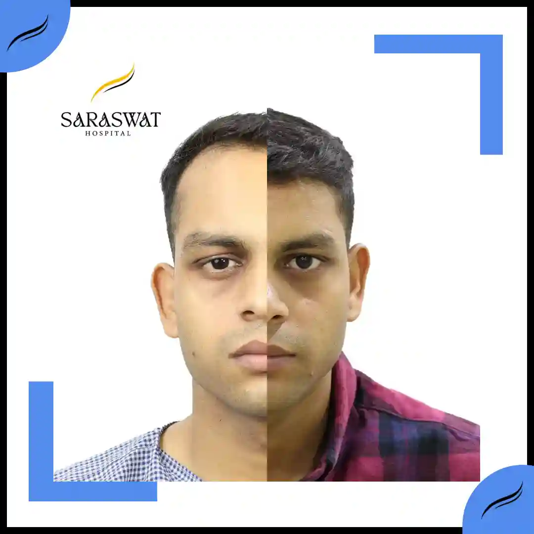 Hair Transplant Before and After | Hair Transplant Results