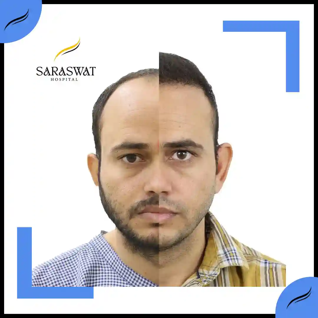 Hair Transplant Before and After | Hair Transplant Results