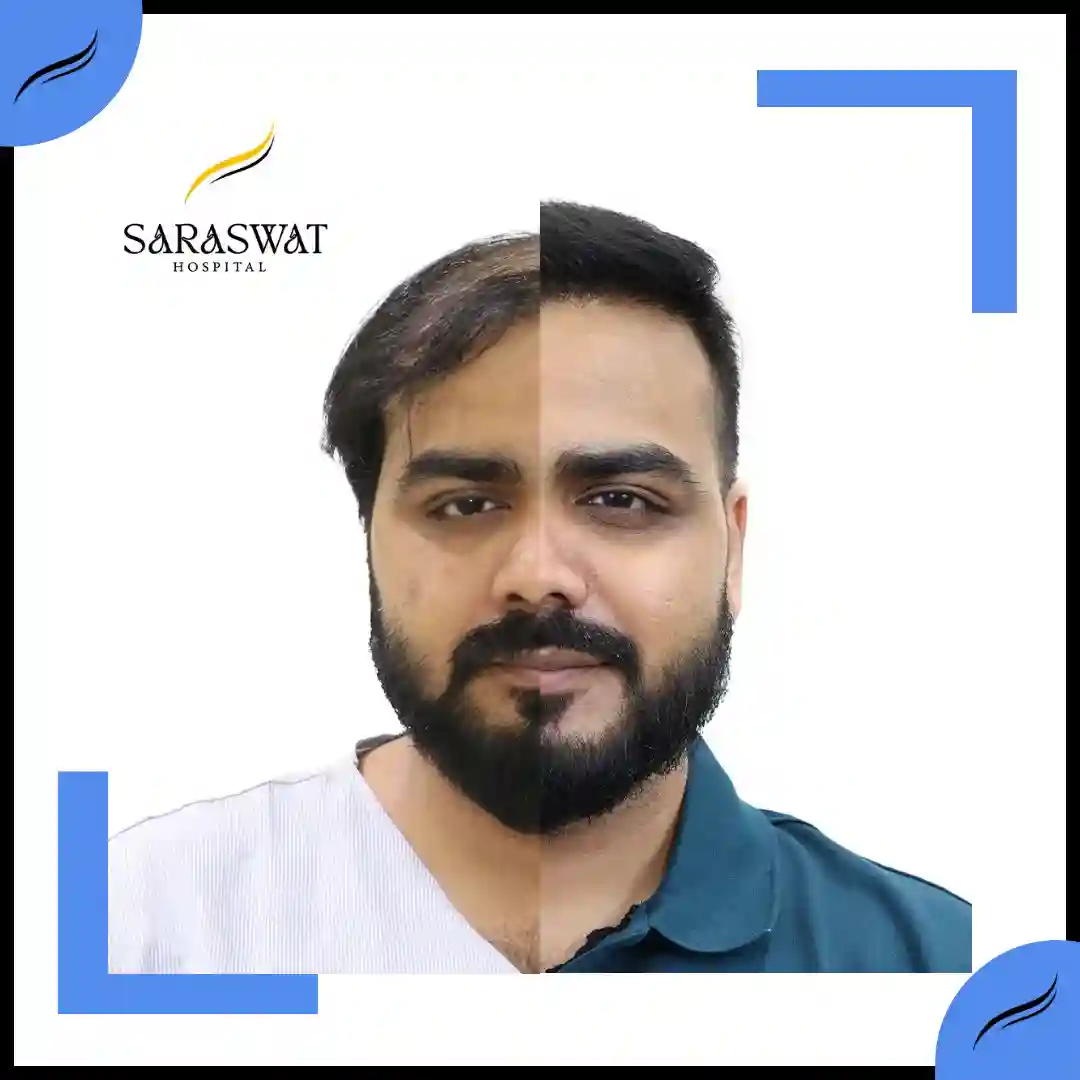 Hair Transplant Before and After Results | Hair Transplant Results