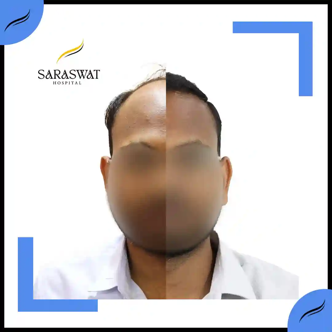 Hair Transplant Before and After | Hair Transplant Results
