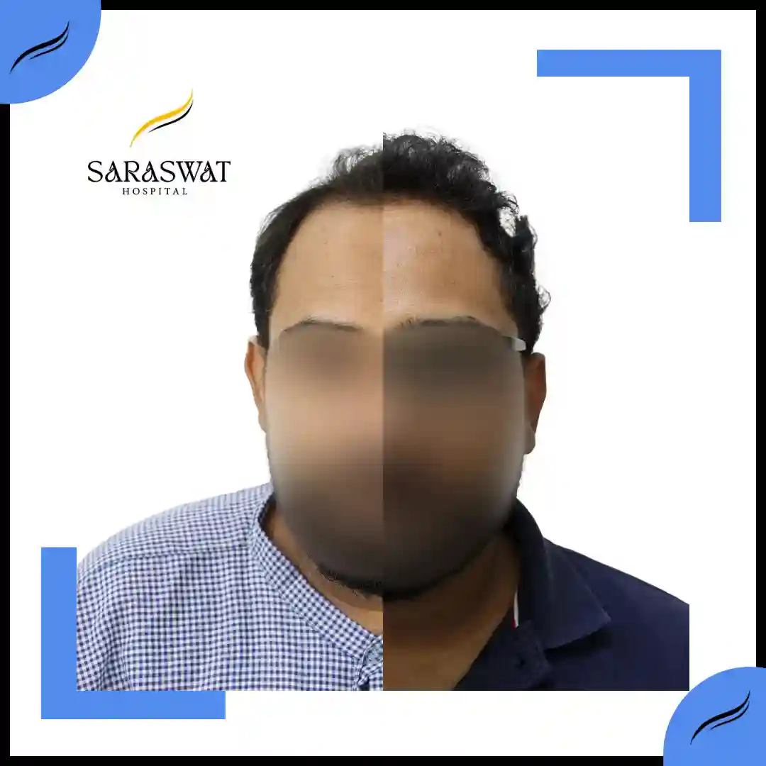 Hair Transplant Before and After | Hair Transplant Results