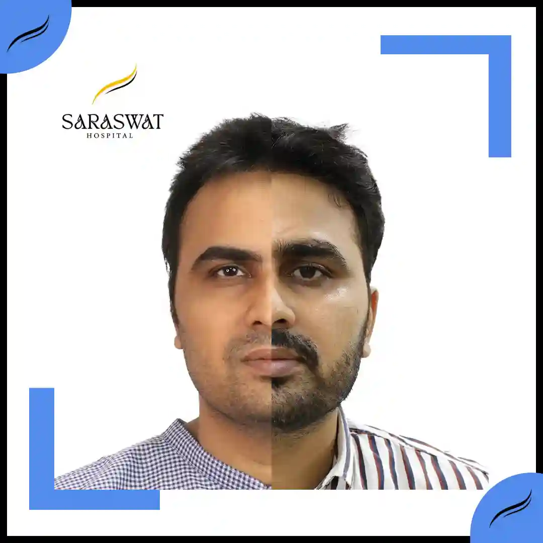 Hair Transplant Before and After | Hair Transplant Results