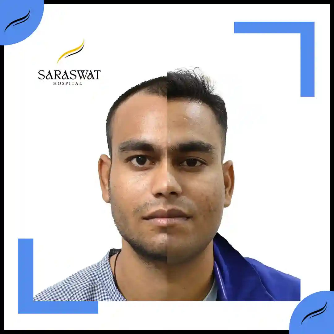 Hair Transplant Before and After | Hair Transplant Results