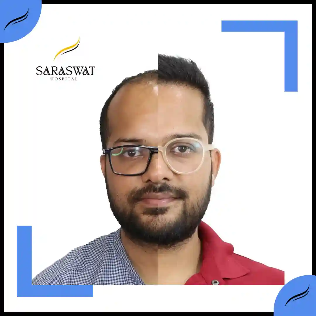 Hair Transplant Before and After | Hair Transplant Results