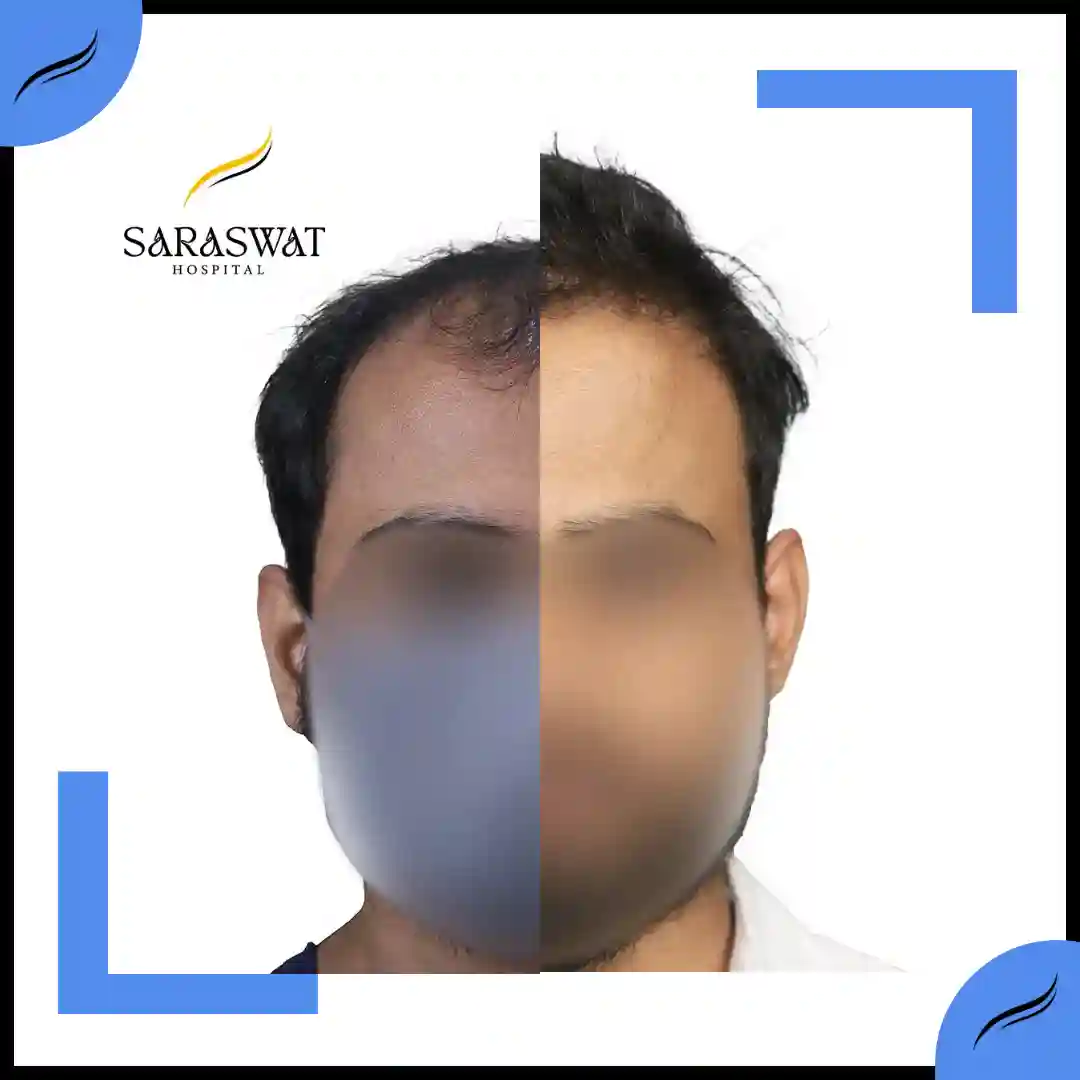 Hair Transplant Before and After | Hair Transplant Results | Hair Transplant Agra