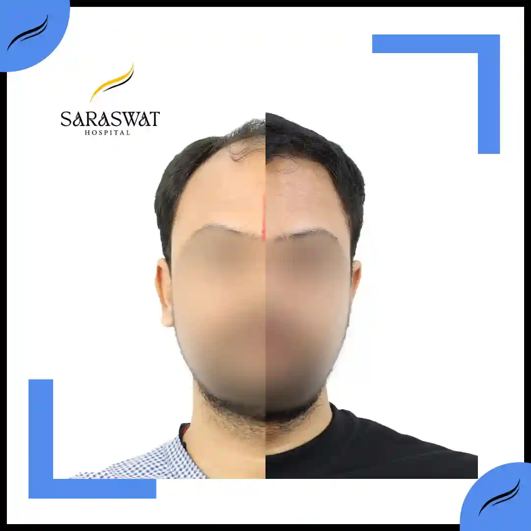 Hair Transplant Before and After | Hair Transplant Results | Hair Transplant Agra