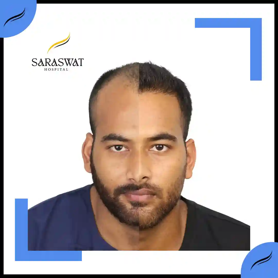 Hair Transplant Before and After | Hair Transplant Results | Hair Transplant Agra