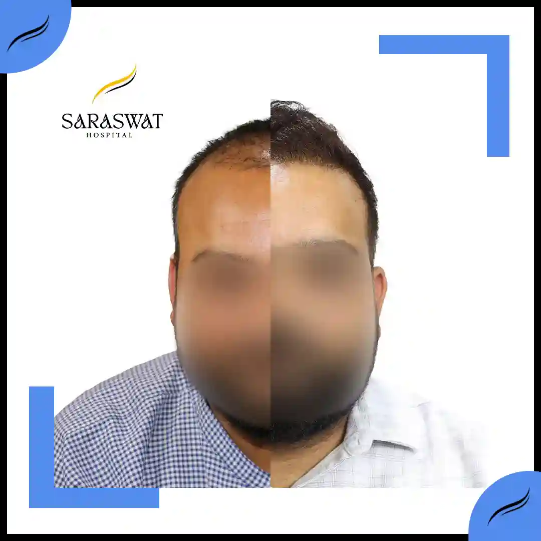 Hair Transplant Before and After | Hair Transplant Results | Hair Transplant Agra