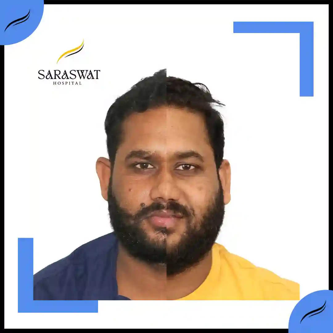 Hair Transplant Before and After | Hair Transplant Results | Hair Transplant Agra