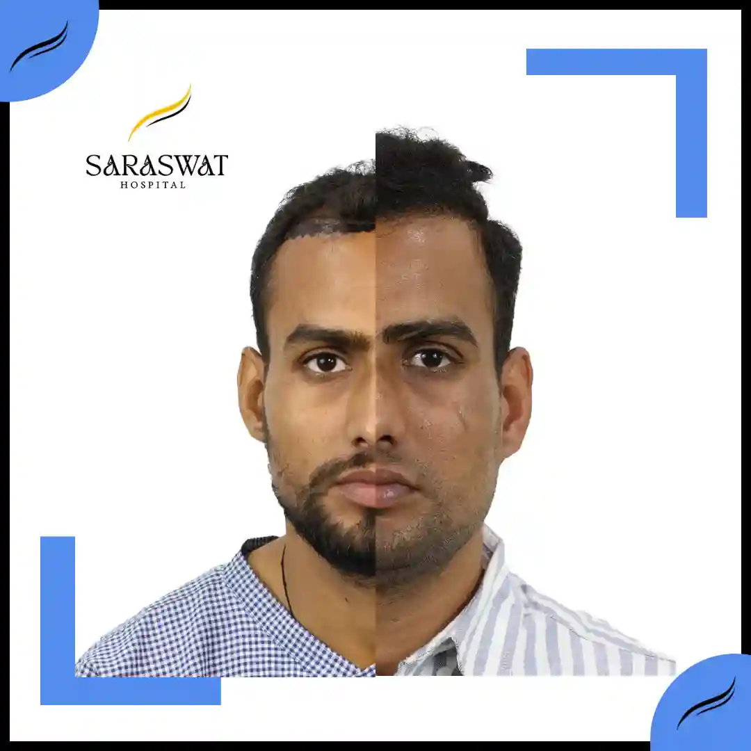 Hair Transplant Before and After | Hair Transplant Results | Hair Transplant Agra