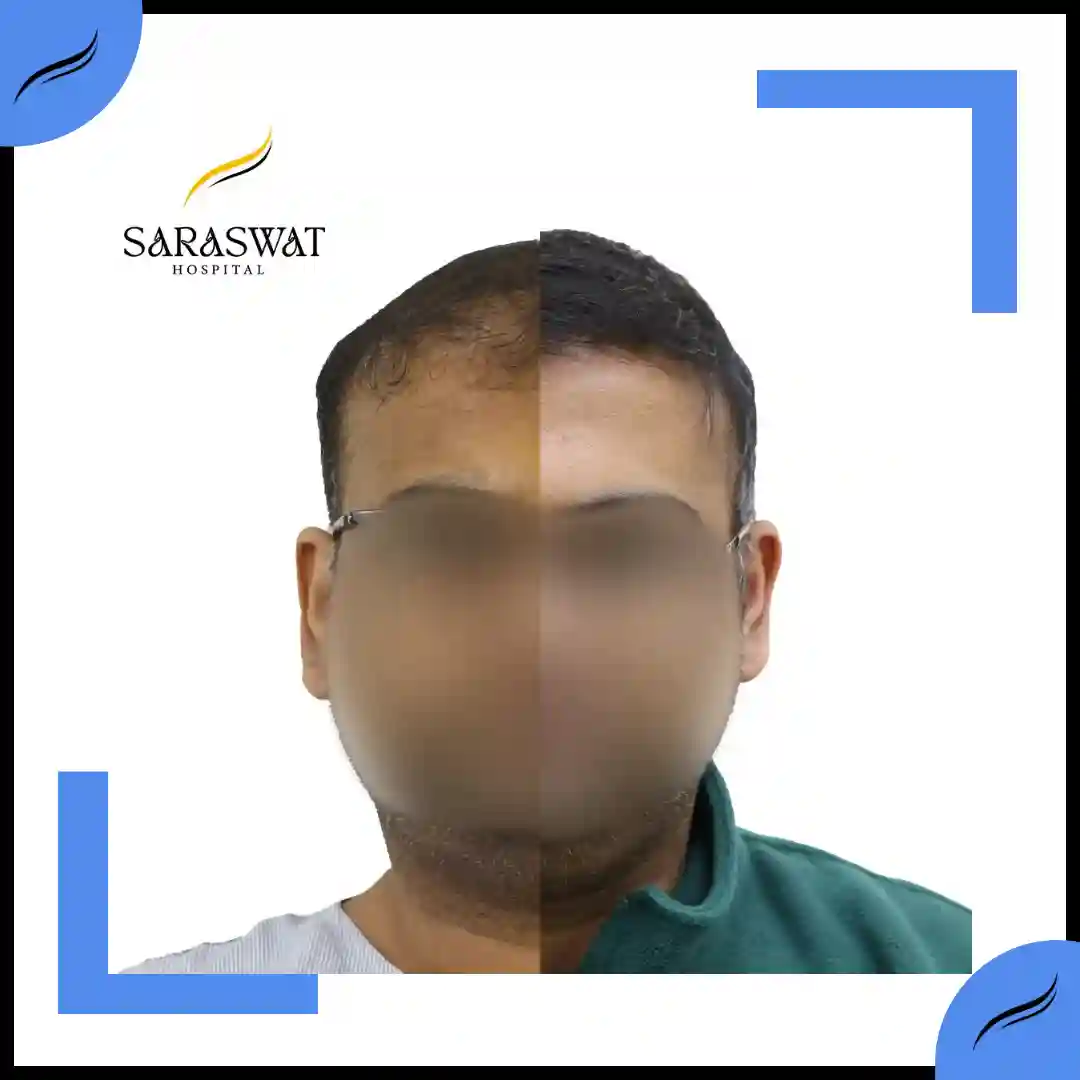 Hair Transplant Before and After | Hair Transplant Results | Hair Transplant Agra