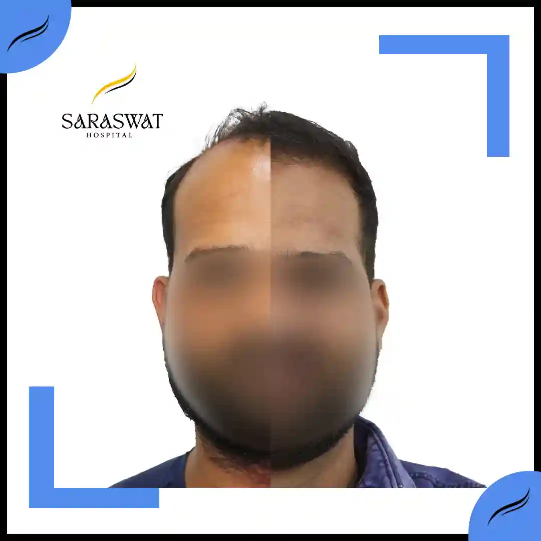 Hair Transplant Before and After | Hair Transplant Results | Hair Transplant Agra