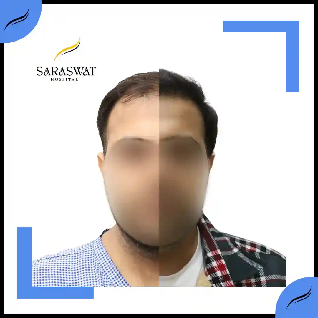 Hair Transplant Before and After | Hair Transplant Results | Hair Transplant Agra
