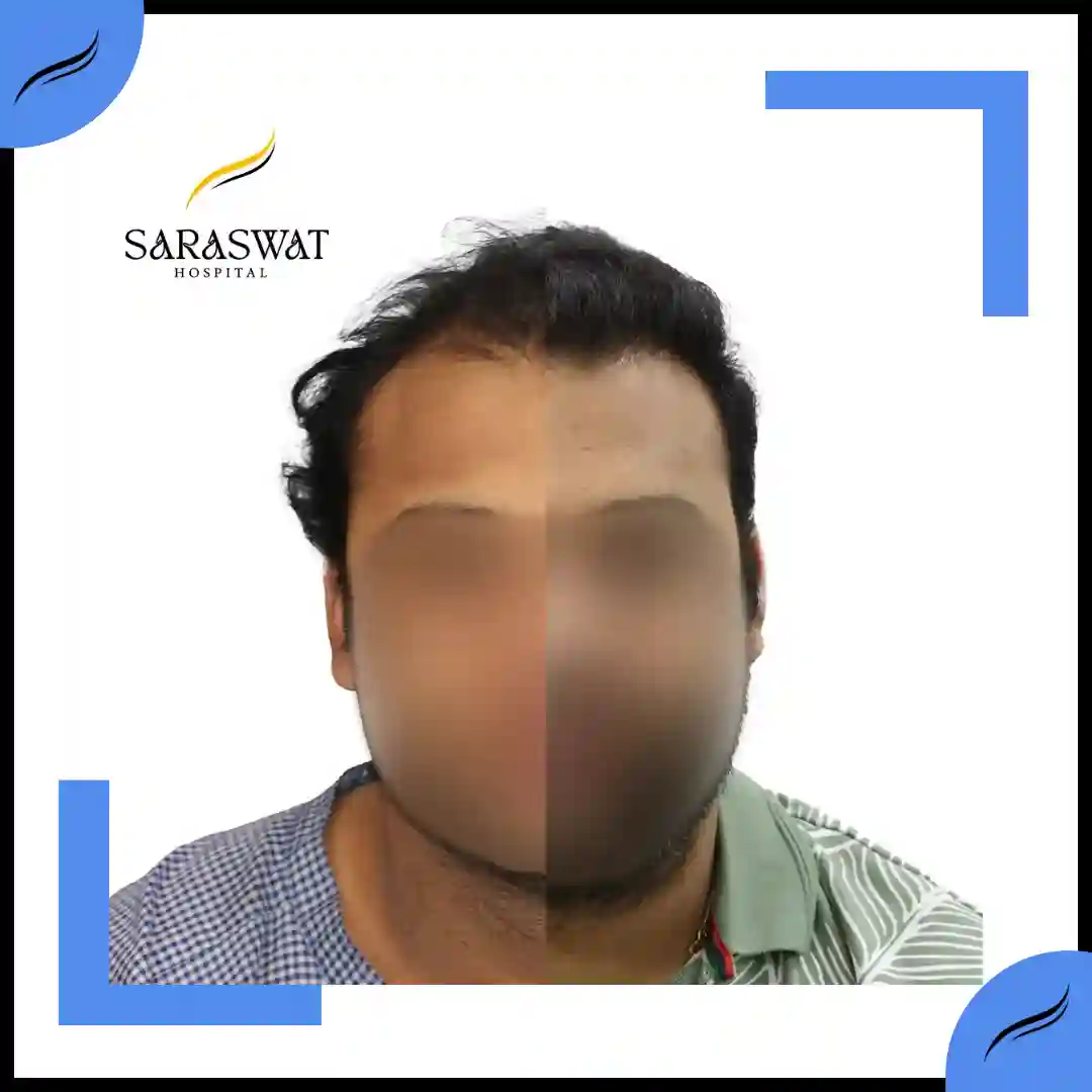 Hair Transplant Before and After | Hair Transplant Results | Hair Transplant Agra