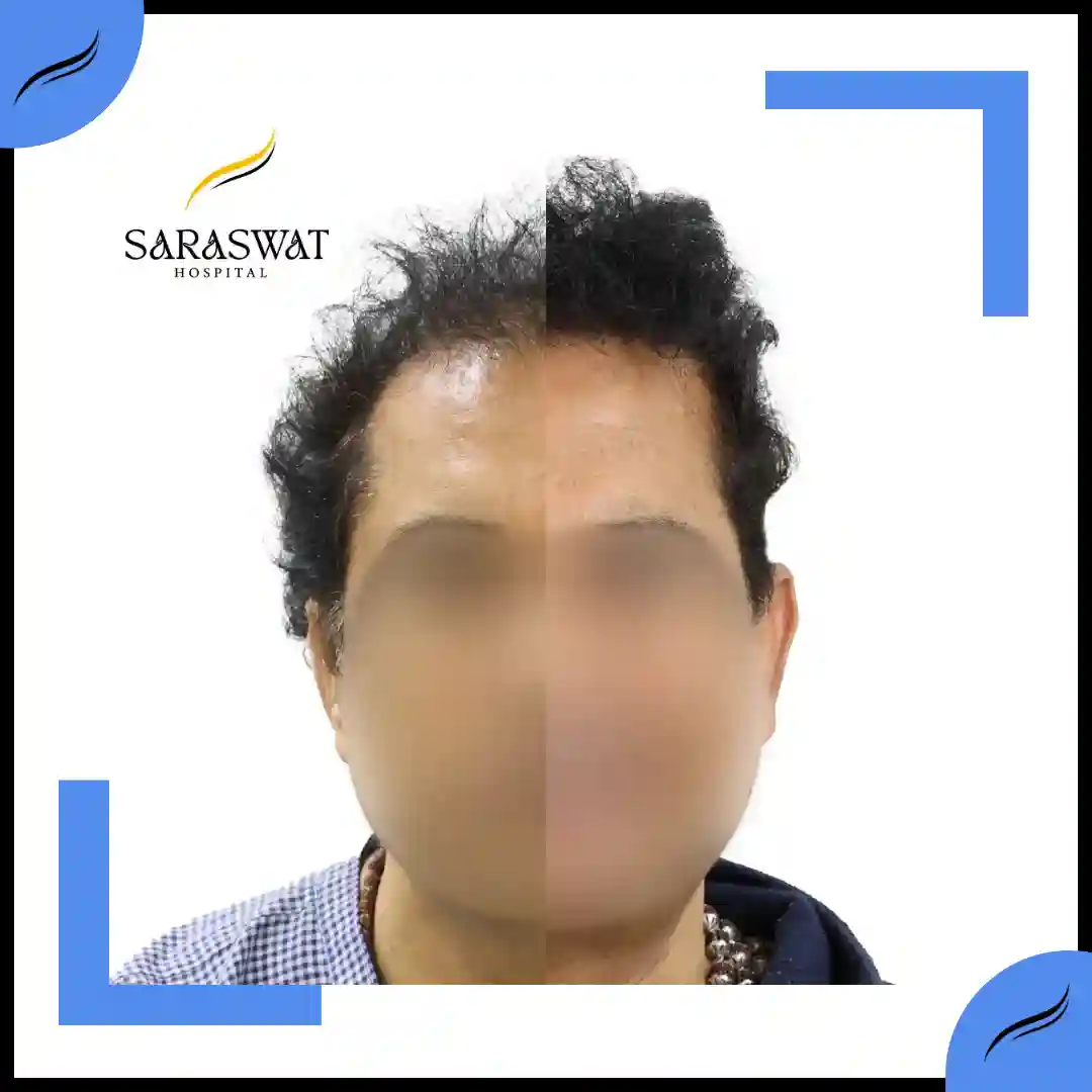 Hair Transplant Before and After | Hair Transplant Results | Hair Transplant Agra