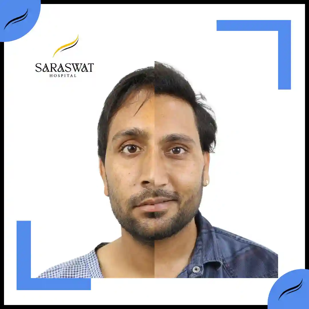 Hair Transplant Before and After | Hair Transplant Results | Hair Transplant Agra