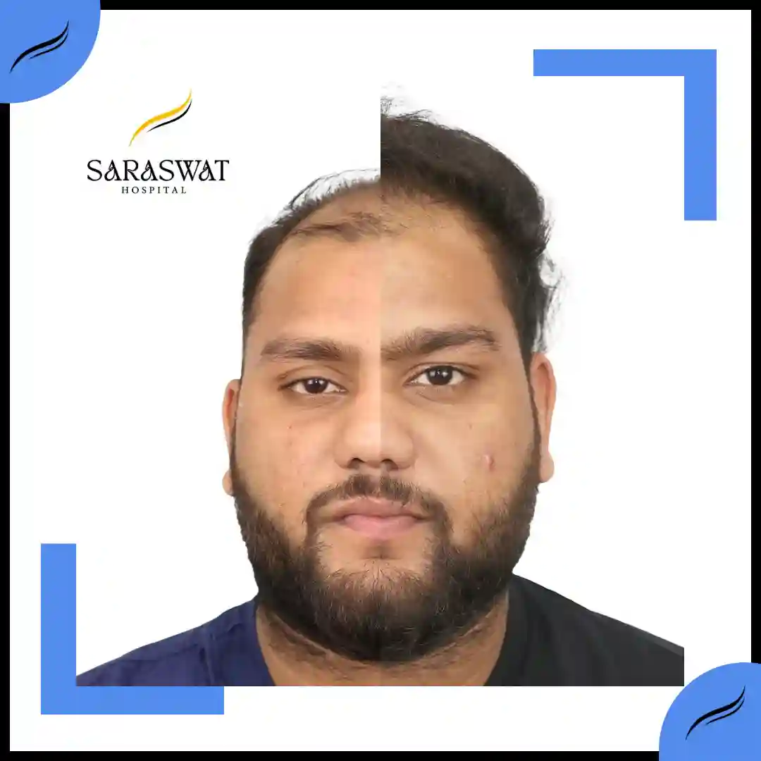 Hair Transplant Before and After | Hair Transplant Results | Hair Transplant Agra
