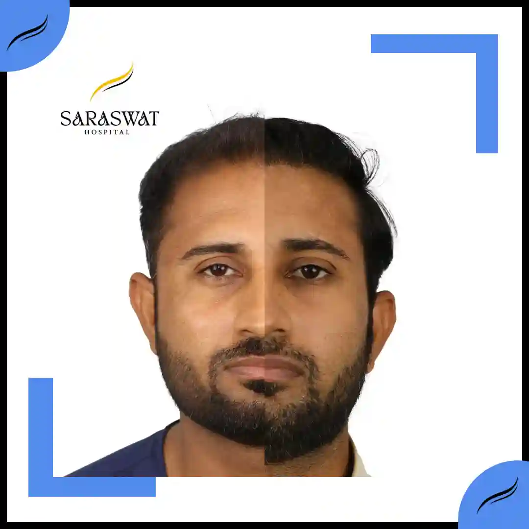 Hair Transplant Before and After | Hair Transplant Results | Hair Transplant Agra