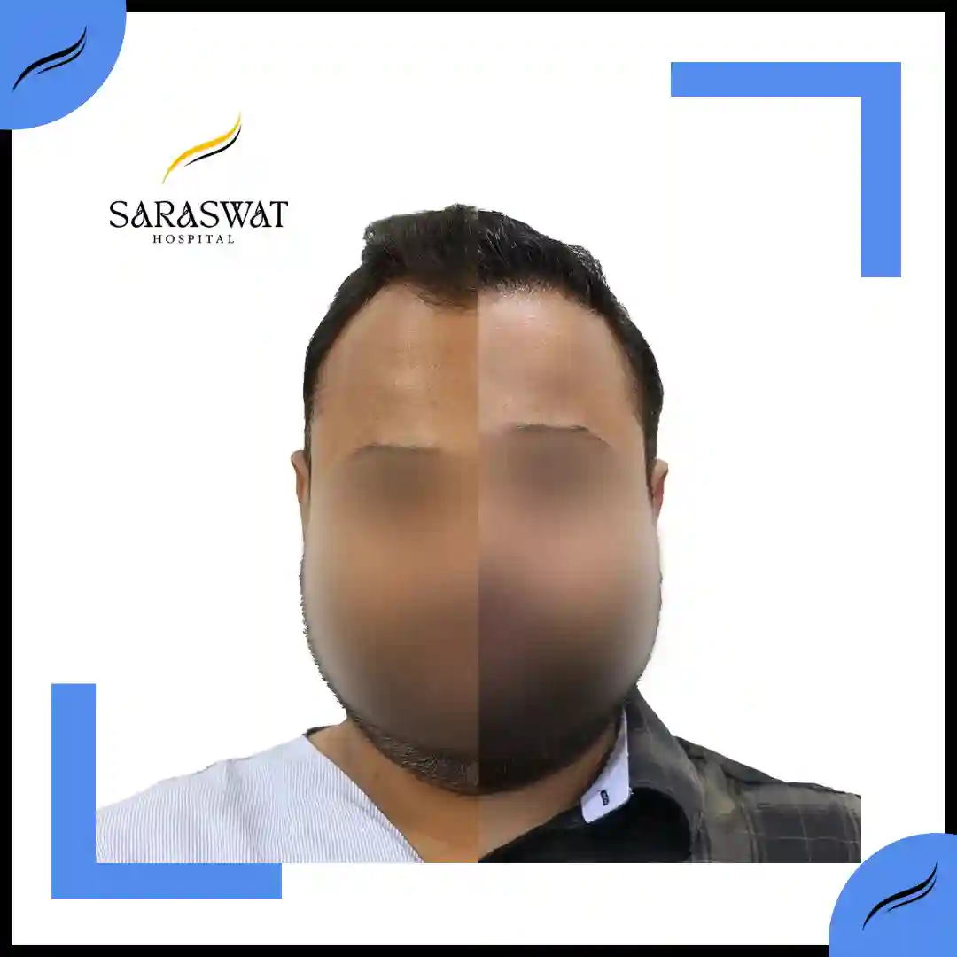 Hair Transplant Before and After | Hair Transplant Results | Hair Transplant Agra