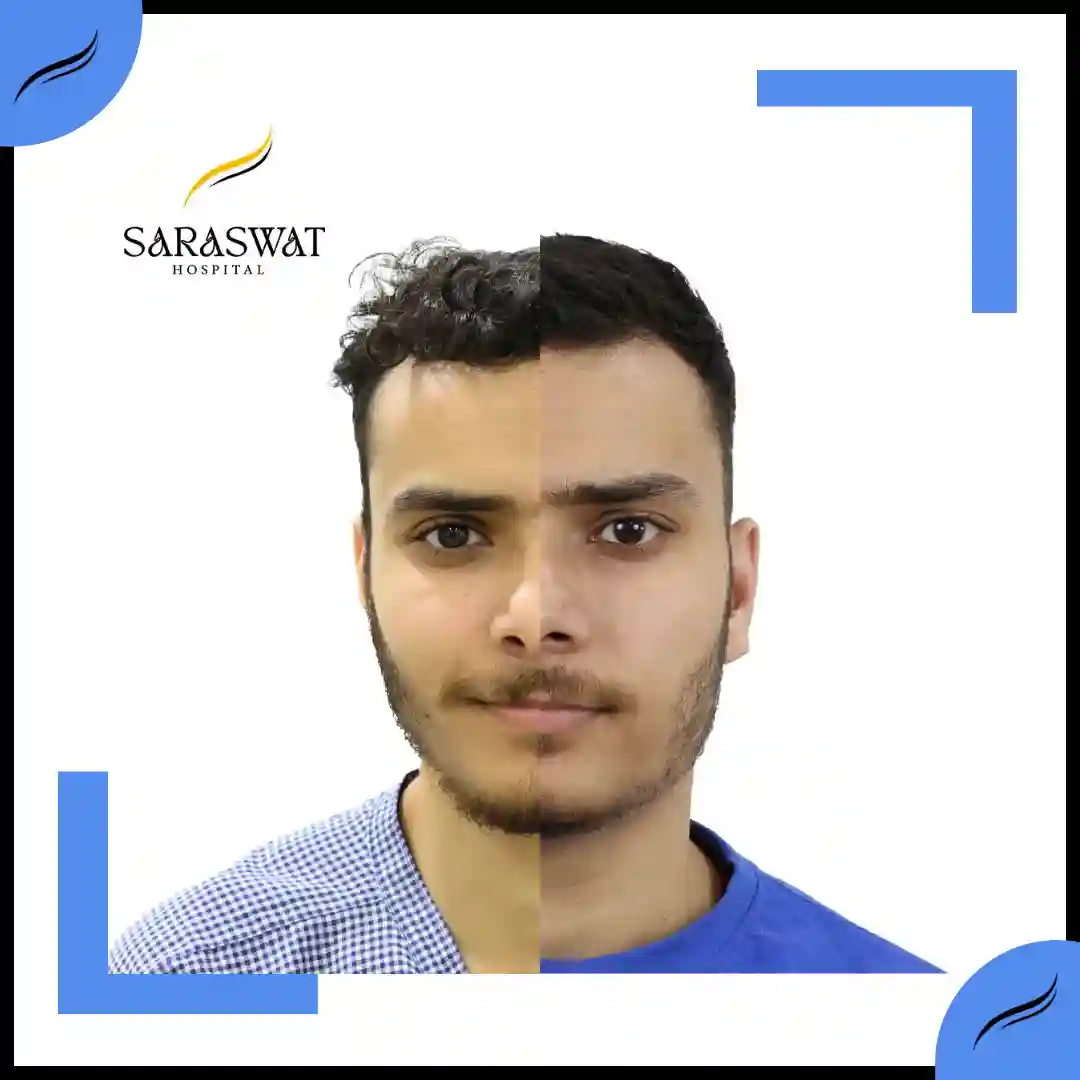 Hair Transplant Before and After | Hair Transplant Results