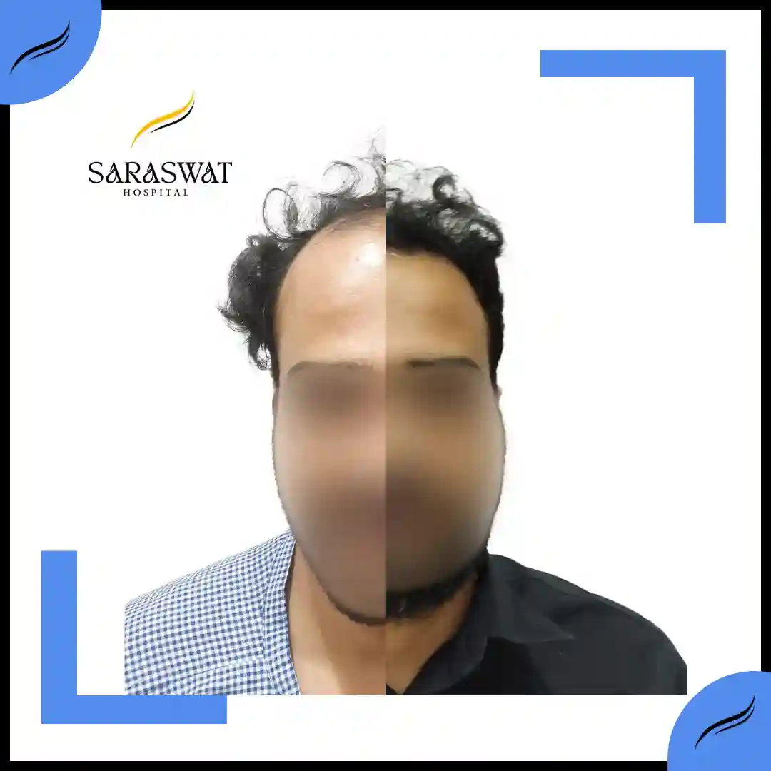 Hair Transplant Before and After