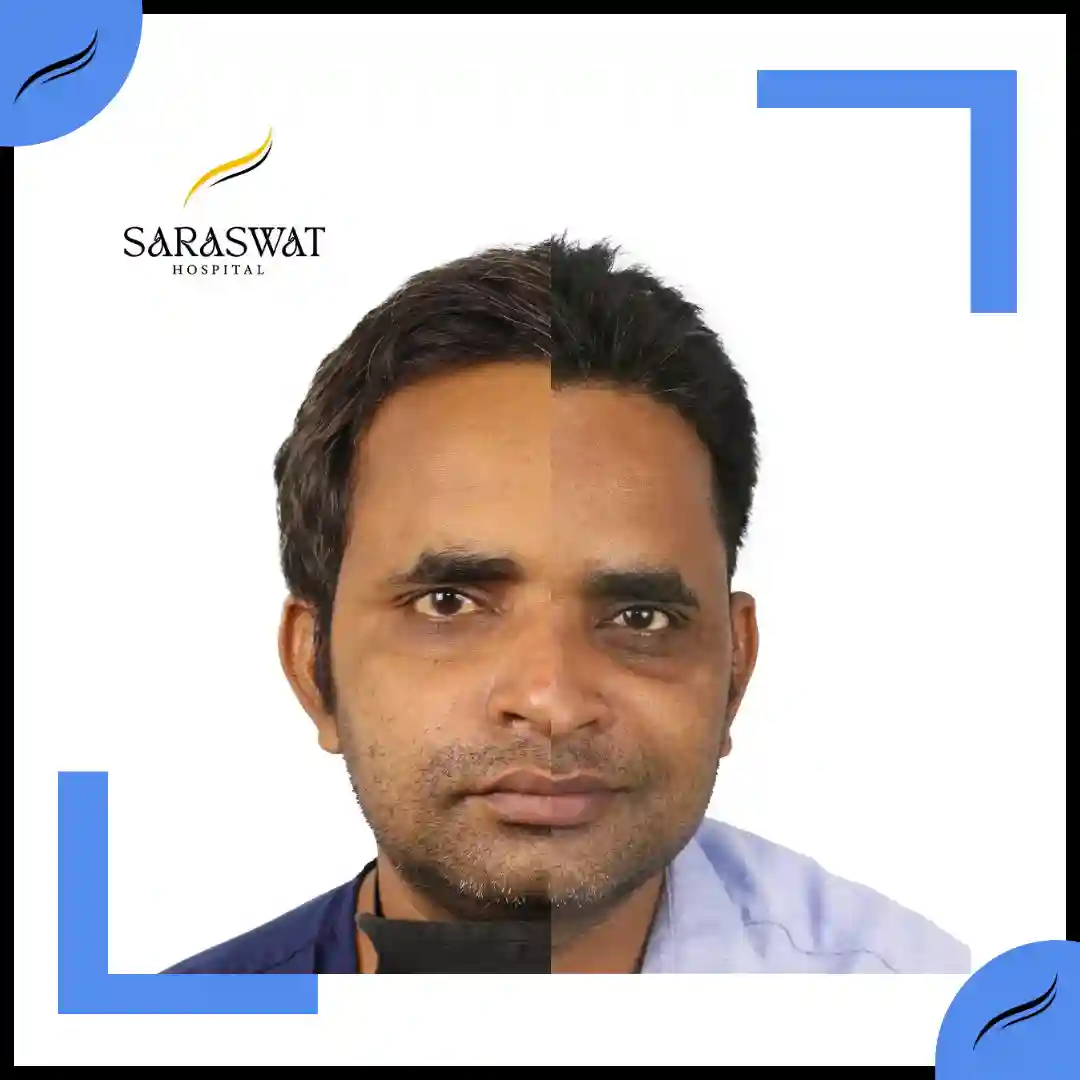 Hair Transplant Before and After | Hair Transplant Results | Hair Transplant Agra
