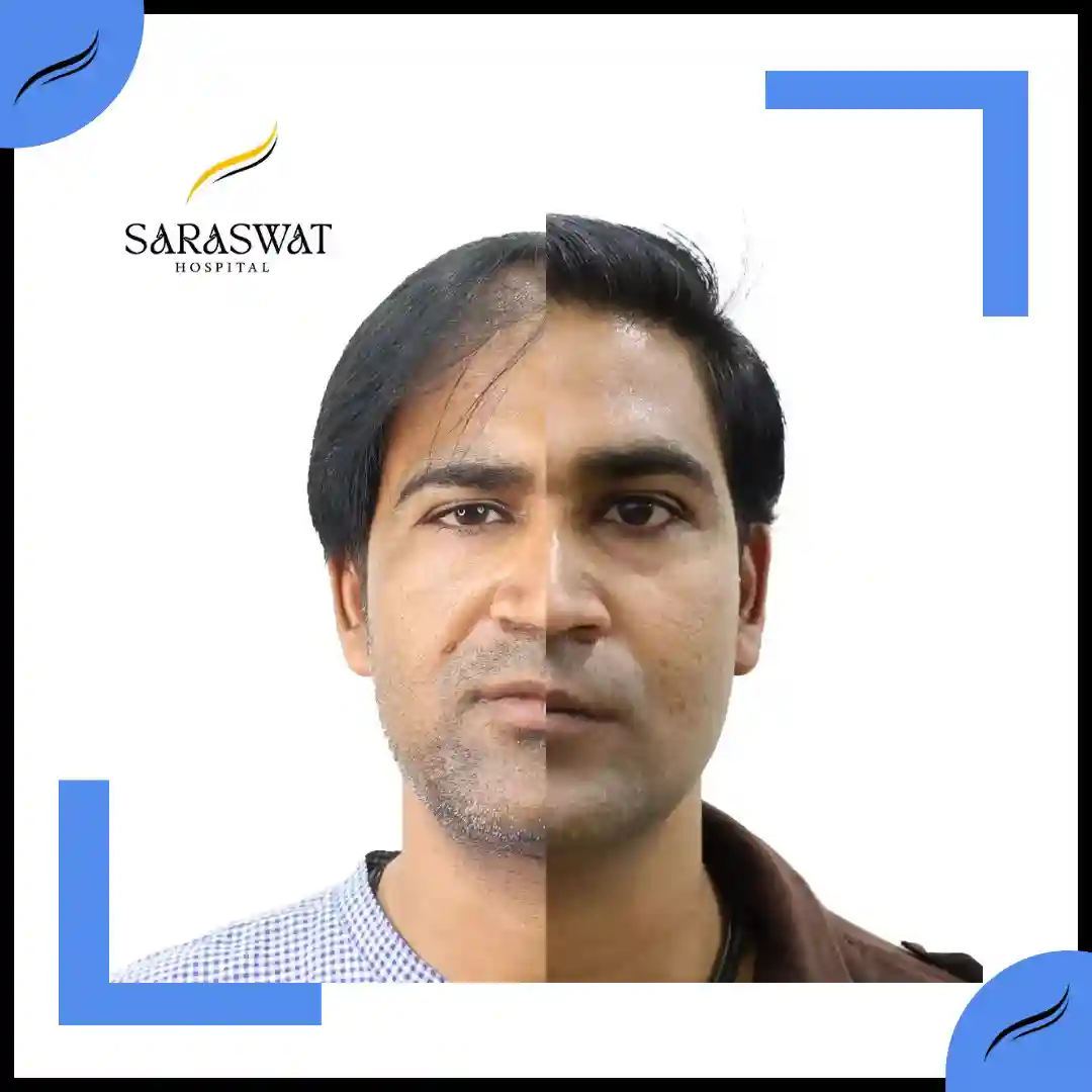 Hair Transplant Before and After | Hair Transplant Results | Hair Transplant Agra