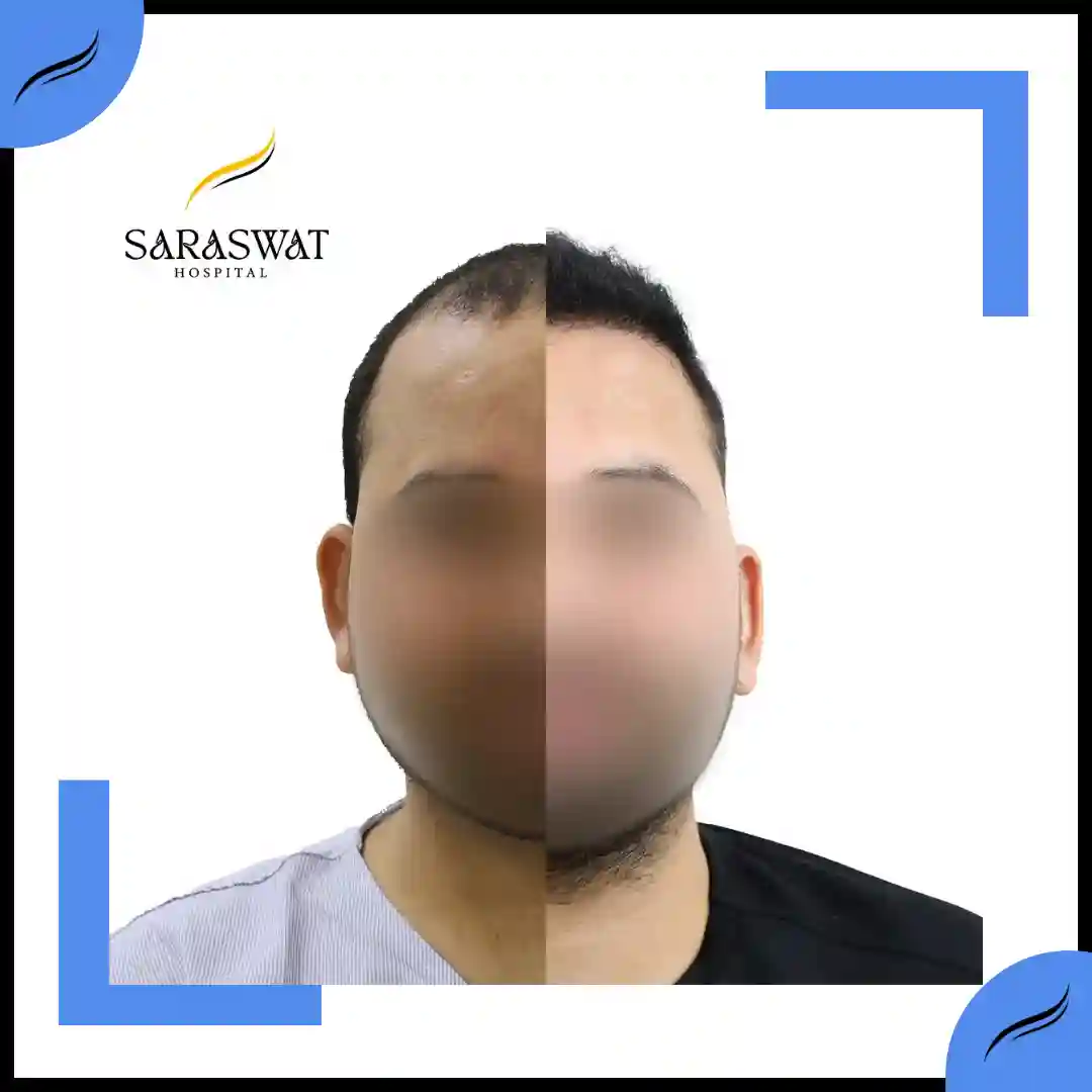 Hair Transplant Before and After | Hair Transplant Results | Hair Transplant Agra