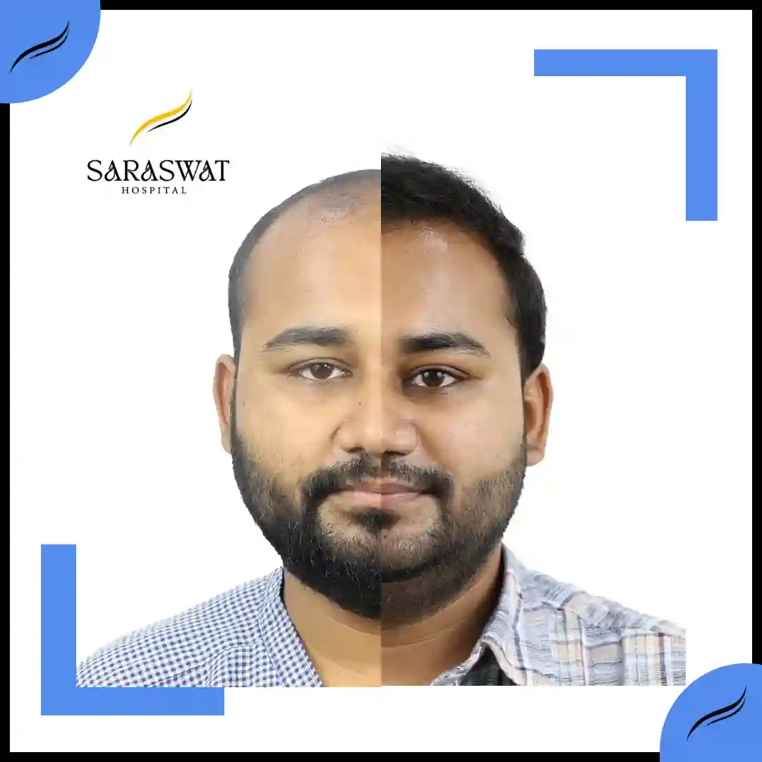 Hair Transplant Before and After | Hair Transplant Results | Hair Transplant Agra
