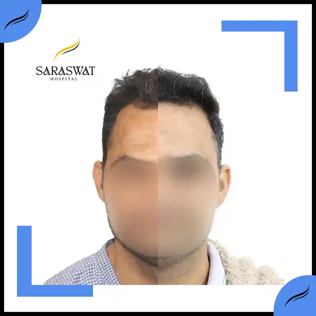 Hair Transplant Before and After | Hair Transplant Results | Hair Transplant Agra