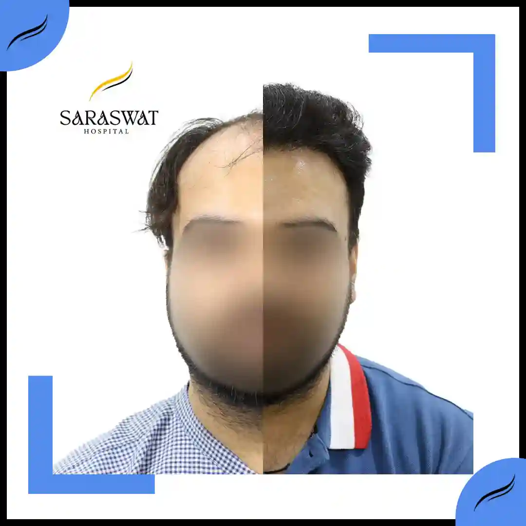 Hair Transplant Before and After | Hair Transplant Results | Hair Transplant Agra