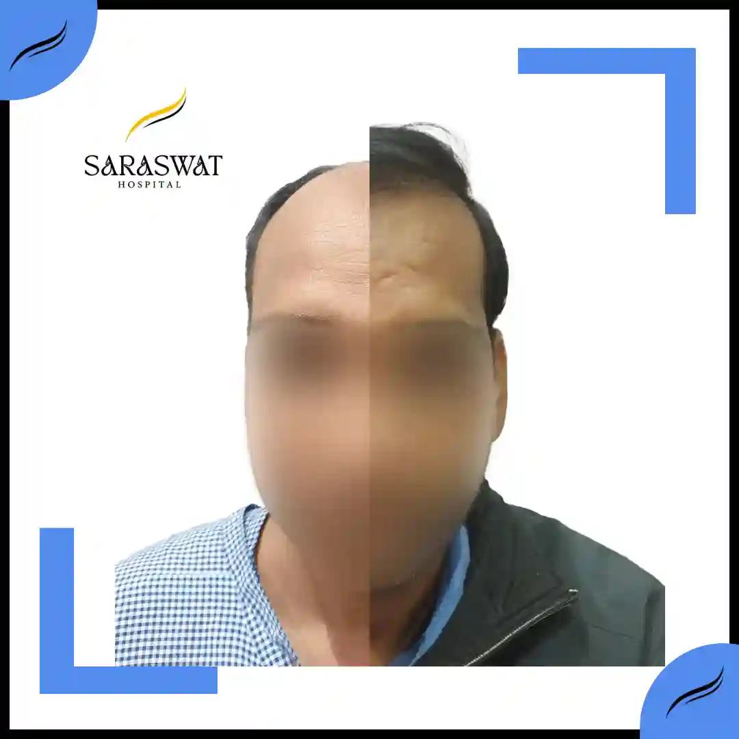 Hair Transplant Before and After