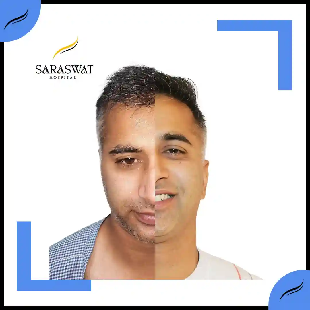 Hair Transplant Before and After | Hair Transplant Results | Hair Transplant Agra